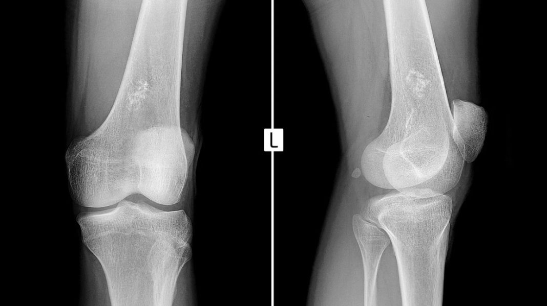 Symptom, causes and treatment of Ewing Sarcoma - The Point